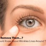 What Should Know About Wrinkles Lines Around The Eyes & How To Remove Them?